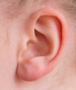 Ear Infections in Children