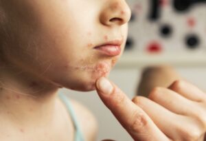 Chickenpox in Kids: Symptoms, Treatment & Prevention