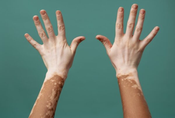 What is Contagious Rate of Vitiligo in Children