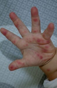 Hand, Foot, and Mouth Disease: Symptoms & Prevention