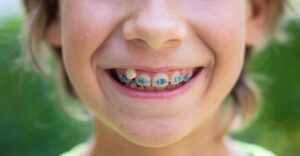 What’s the Best Age for Kids to Get Braces? A Simple Guide for Parents