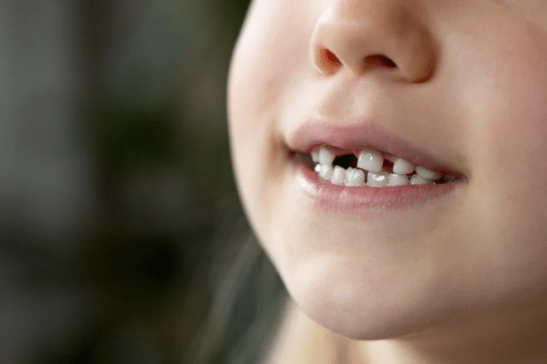 At What Age Are Baby Teeth Replaced