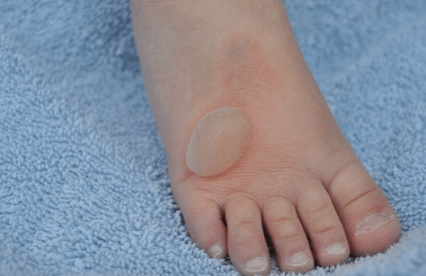 Children’s Burns: How to Handle Them Safely