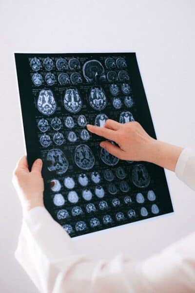 How MRI Detects Cortical Dysplasia in Kids?