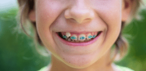 25 Questions Parents Ask About Kids' Braces