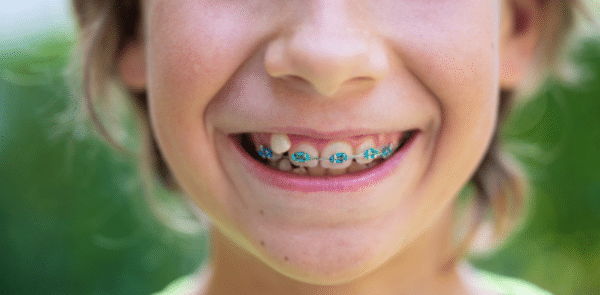 25 Questions Parents Ask About Kids' Braces