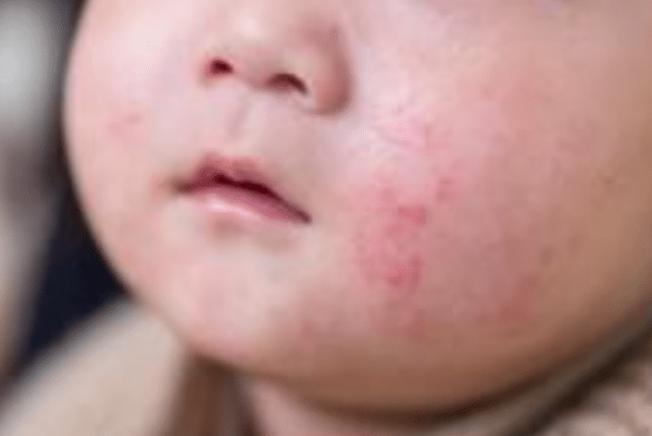 Baby Eczema