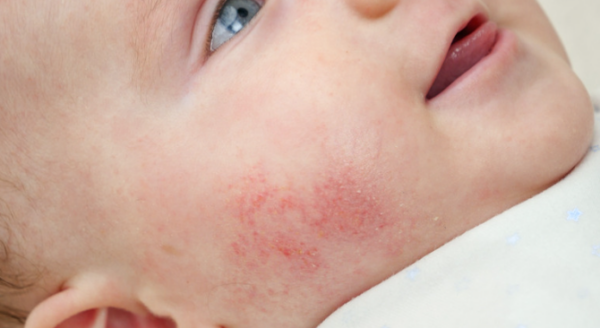 Baby Face Rash: 6 Common Causes Every Parent Should Know