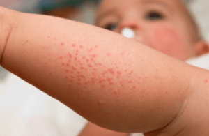 Heat Rash in Children: Causes, Signs, and Treatment