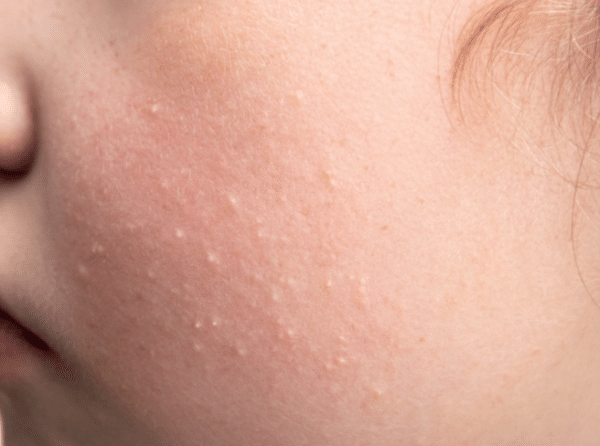Baby Face Rash: 6 Common Causes Every Parent Should Know