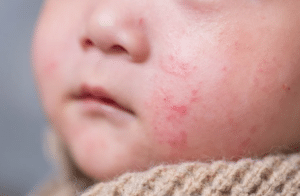 How to Get Rid of Heat Rash in Kids