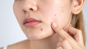 How to Prevent Acne in Teen Girls