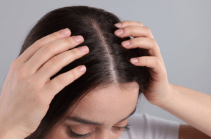 Teen Girls and Dandruff: Causes and Treatments