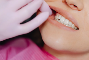 Can Upper and Lower Braces Improve a Child's Bite?
